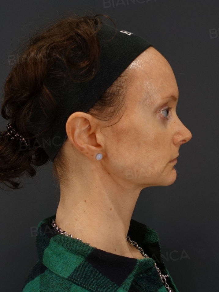 Nasal tip shaping、Nasal tip cartilage graft、Rhinoplasty
