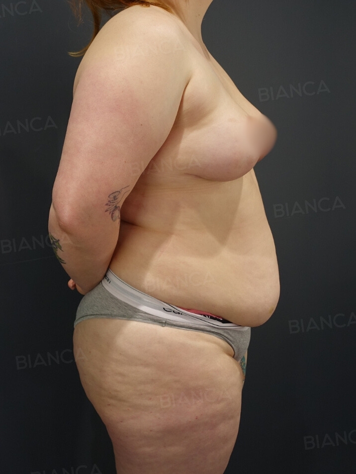 Breast List