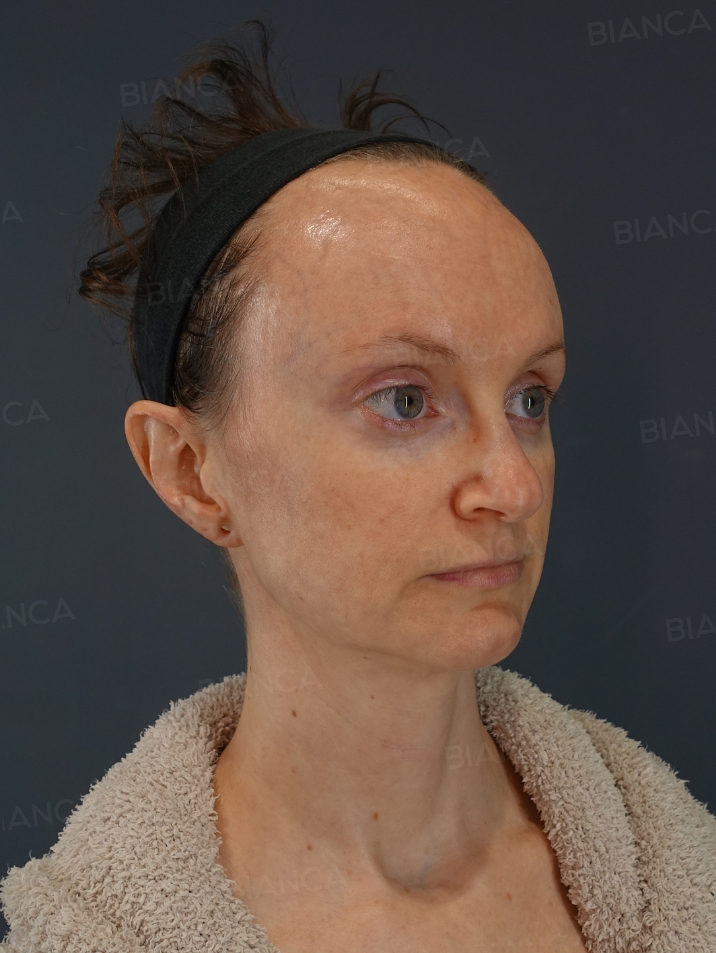Nasal tip shaping、Nasal tip cartilage graft、Rhinoplasty
