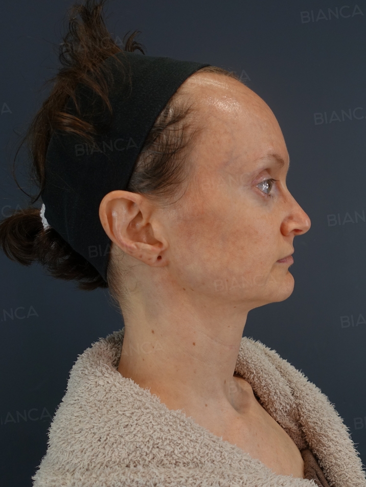 Nasal tip shaping、Nasal tip cartilage graft、Rhinoplasty