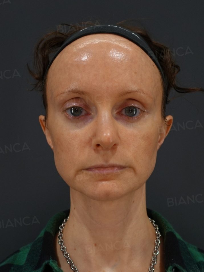 Nasal tip shaping、Nasal tip cartilage graft、Rhinoplasty