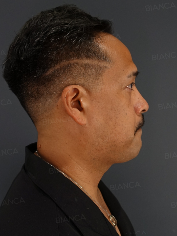 Side View After