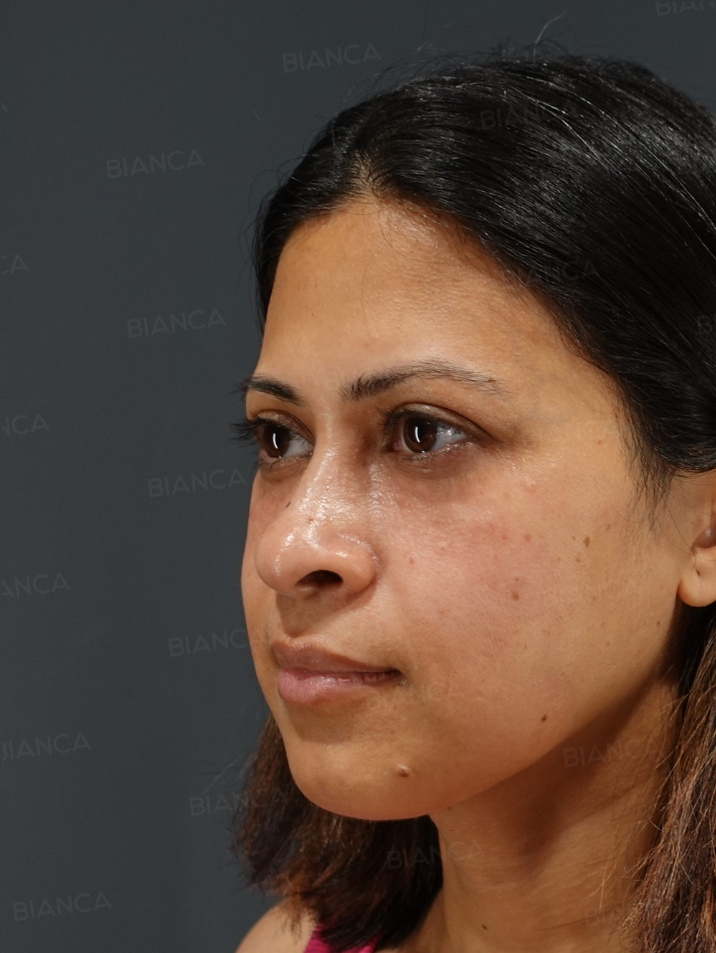 Baby Collagen + Hyaluronic Acid Injection for Under-Eye Dark Circles BIANCA in Tokyo, JapanBaby Collagen + Hyaluronic Acid Injection for Under-Eye Dark Circles BIANCA in Tokyo, JapanBaby Collagen + Hyaluronic Acid Injection for Under-Eye Dark Circles BIANCA in Tokyo, Japan