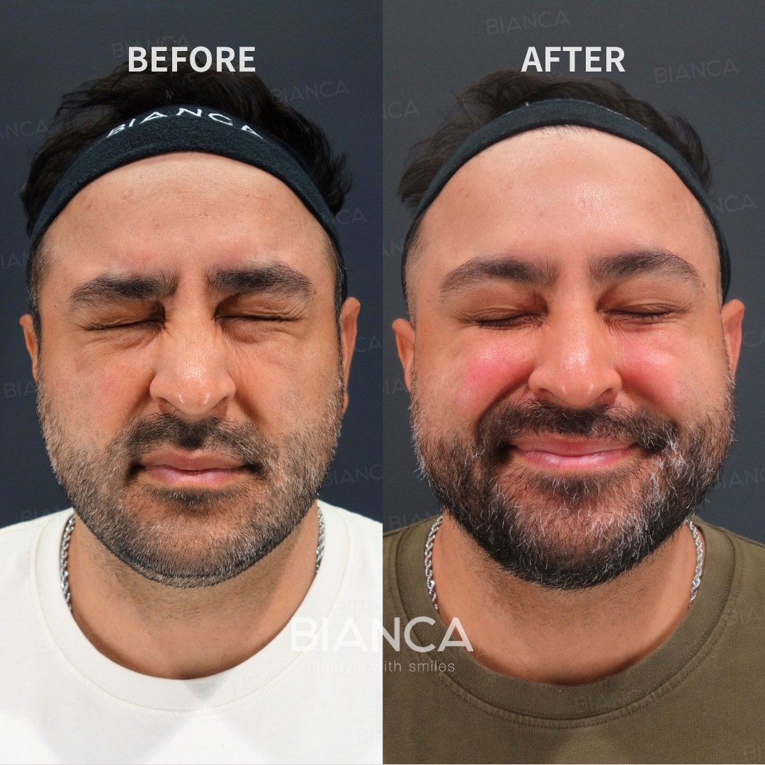 Botox Treatment Forehead Botox / Crow’s Feet Botox (Allergan Botox)