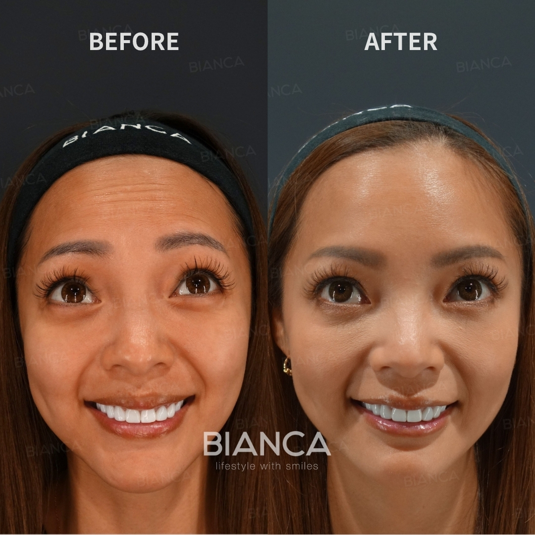 Botox Treatment Forehead Botox (Allergan Botox)
