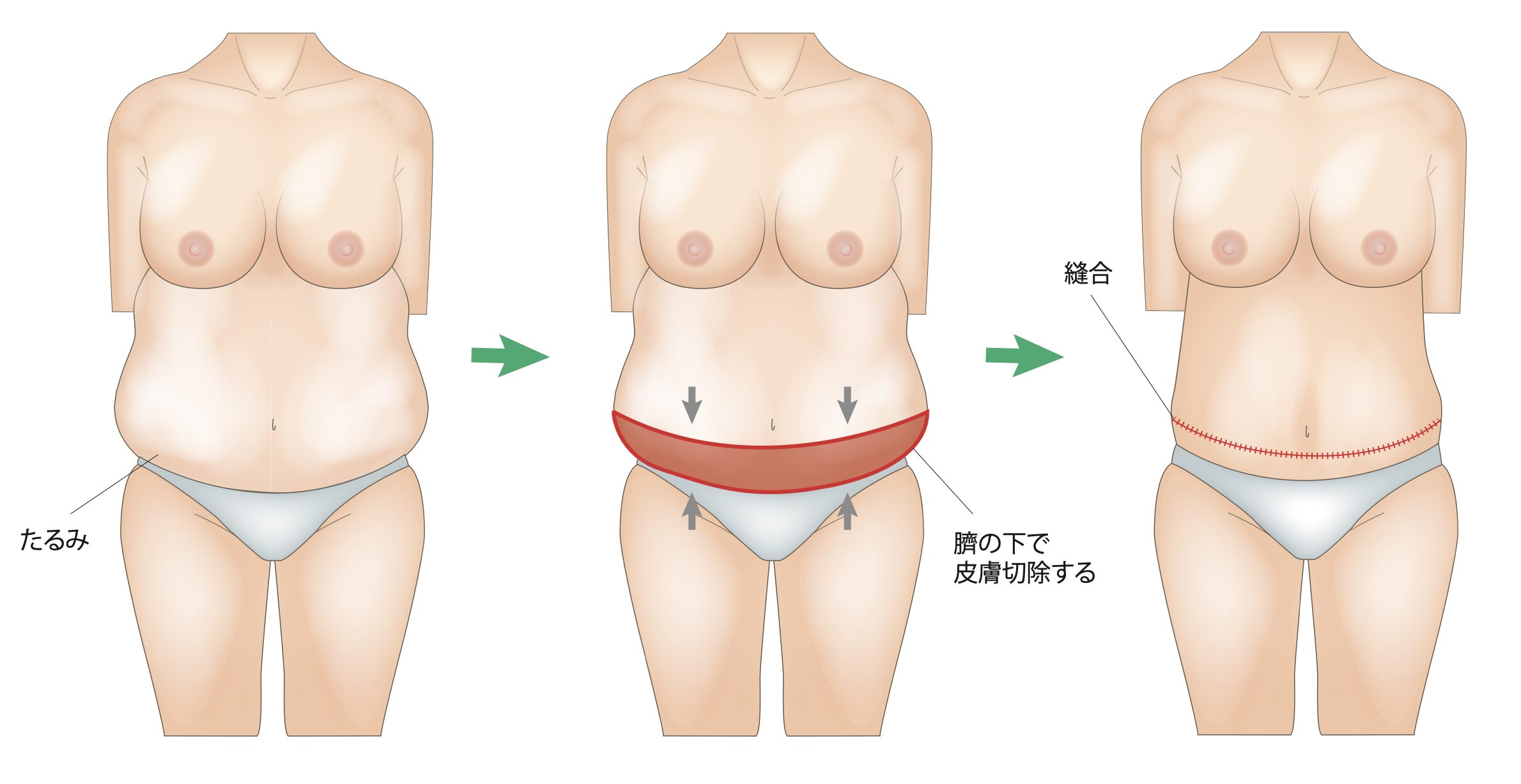 Tummy Tuck