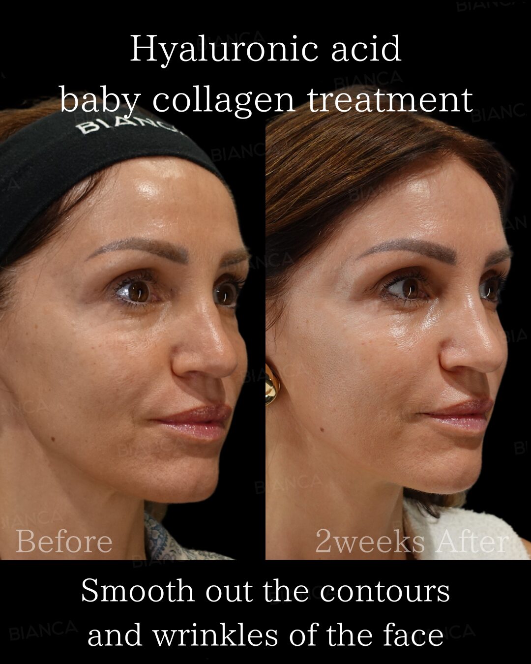 Cheek Fillers and Female Wellness