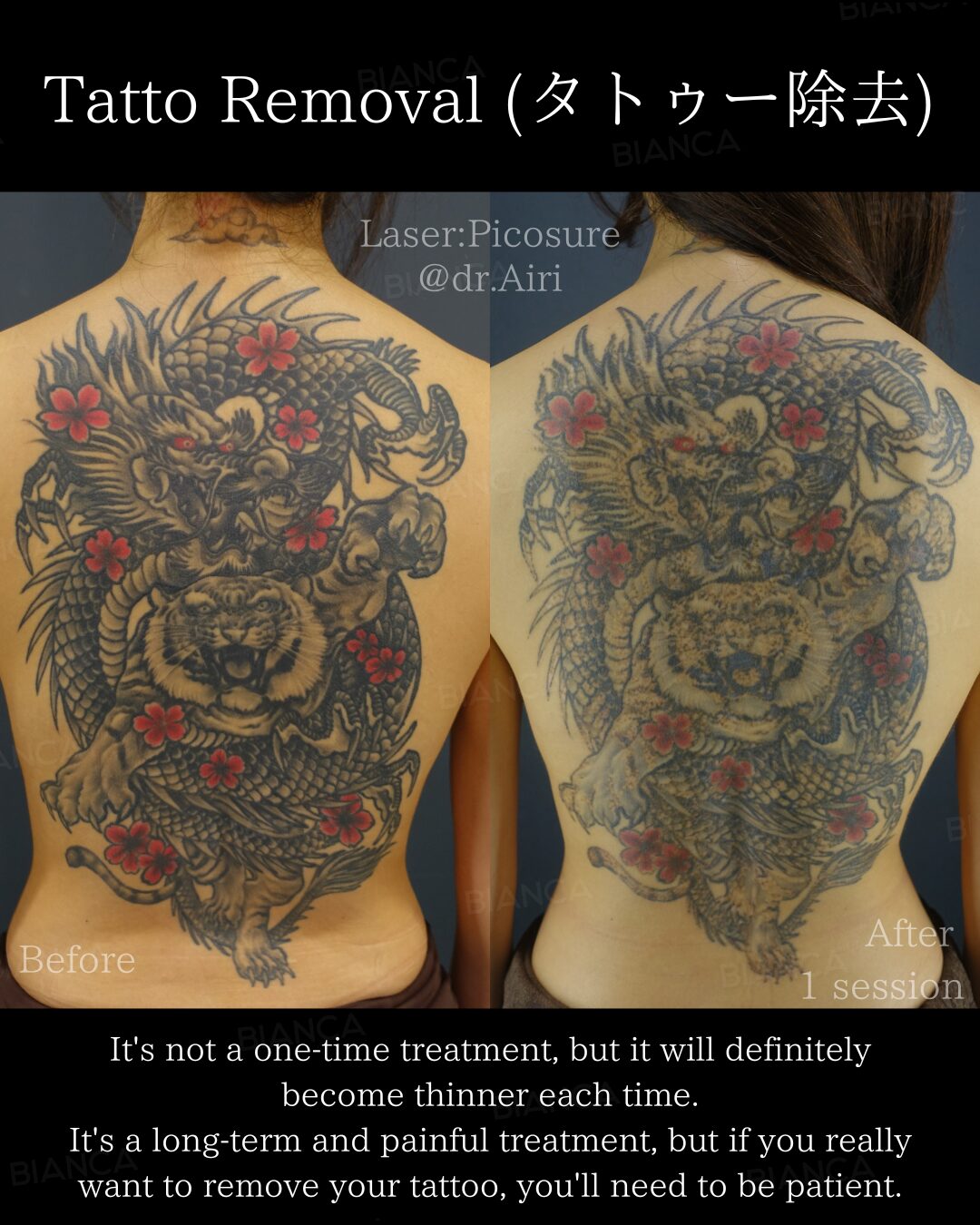 Laser Tattoo Removal Tailored Specifically for International Patients