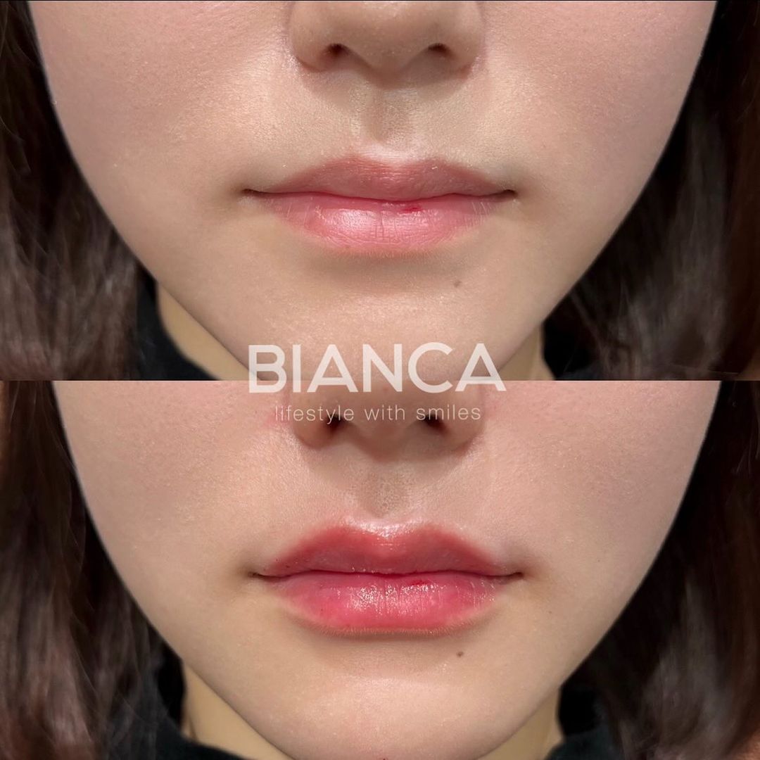Lips Filler for Every Ethnicity: Subtle Results with Cosmetic Surgery Precision