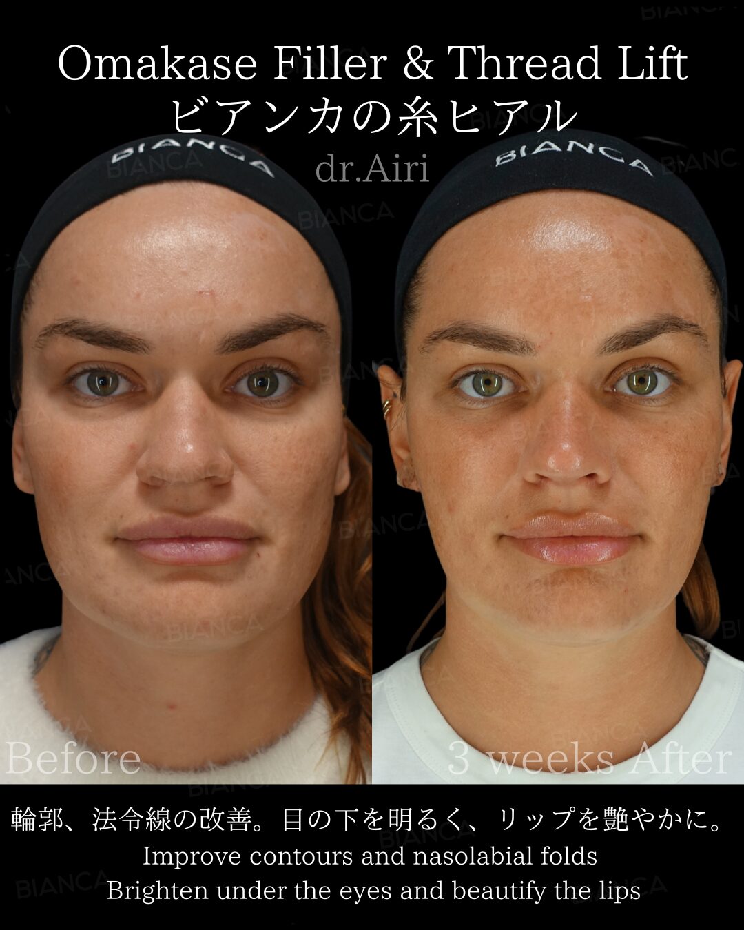 Masseter Botox in Japan Is Reinventing Aesthetic Surgery Practices Around the World