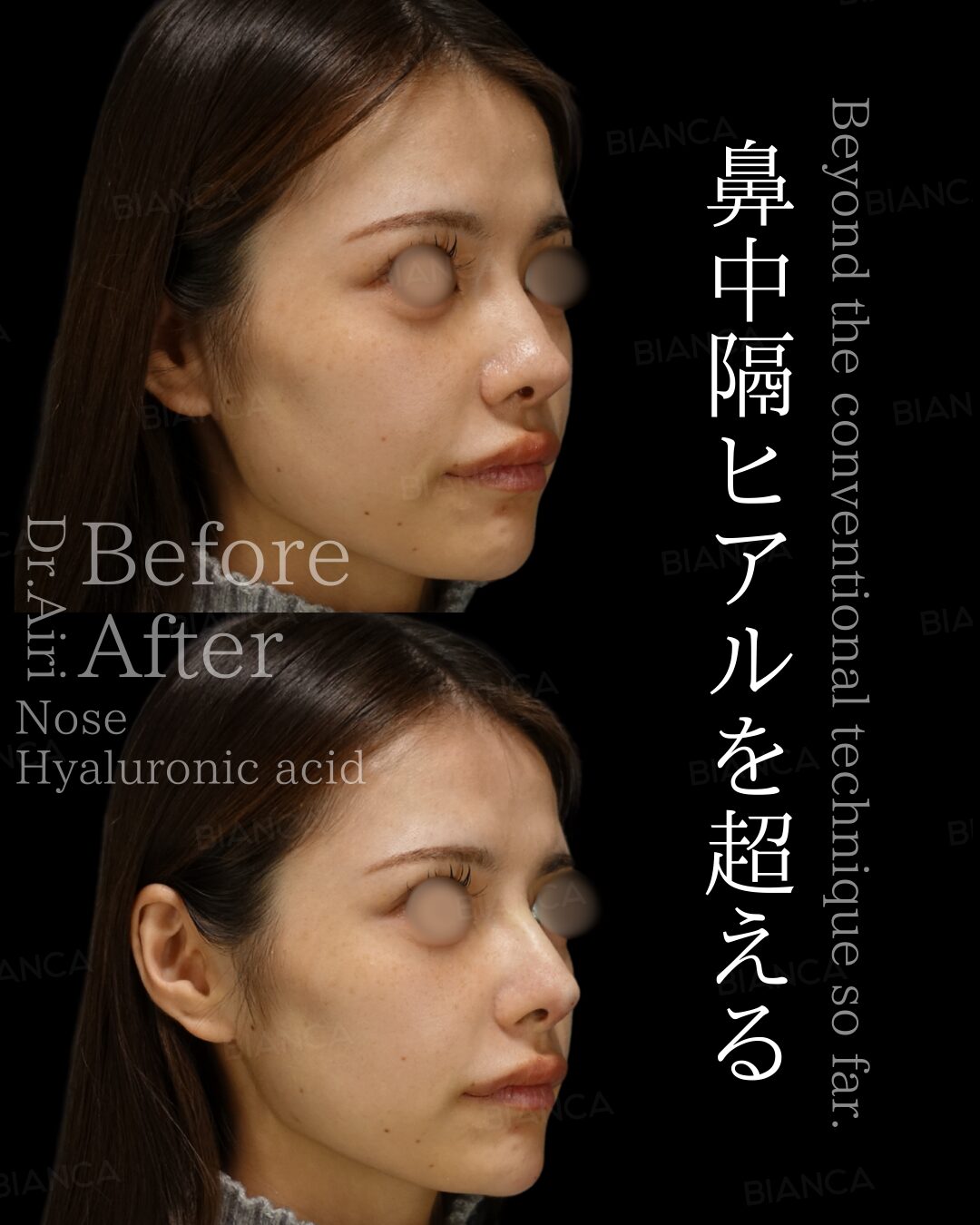 Fillers Before and After