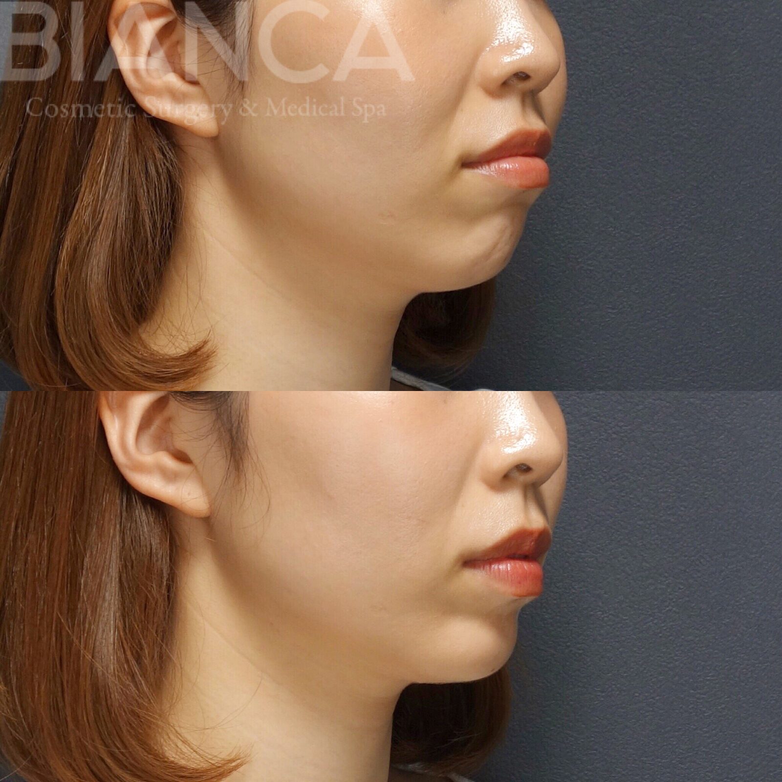 Botox Aftercare Guide for International Patients: Expert Care in Tokyo