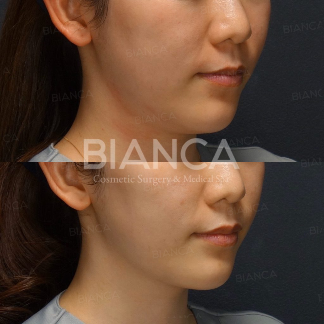HIFU Treatment in Tokyo, in Japan: Expert, Gentle Skin Tightening at a Medical Spa Near Me