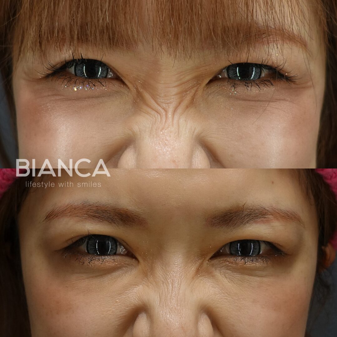 Botox Eyes in Tokyo: A Friendly Guide to Natural, Lasting Brightness