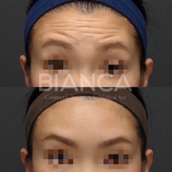 Botox Clinic Near Me in Tokyo: A Calm, Expert Guide to Safe, Natural Results