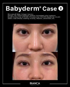 BABYDERM｜Trust BIANCA in Tokyo, Japan tailored to your love handles. love handles BIANCA in Tokyo, Japan