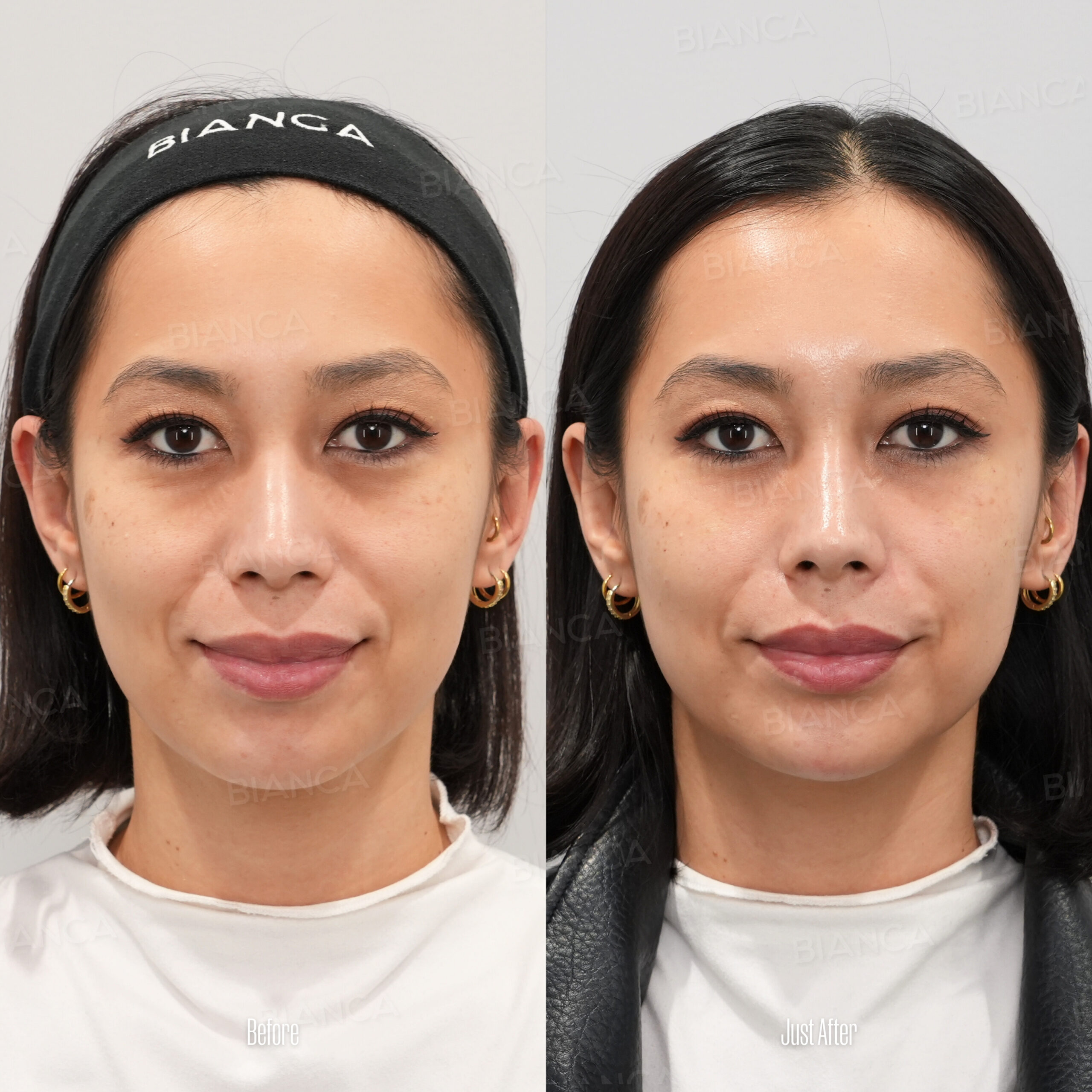 Botox & Dermal Fillers: English- Speaking Aesthetic Surgery at a Top Clinic in Tokyo