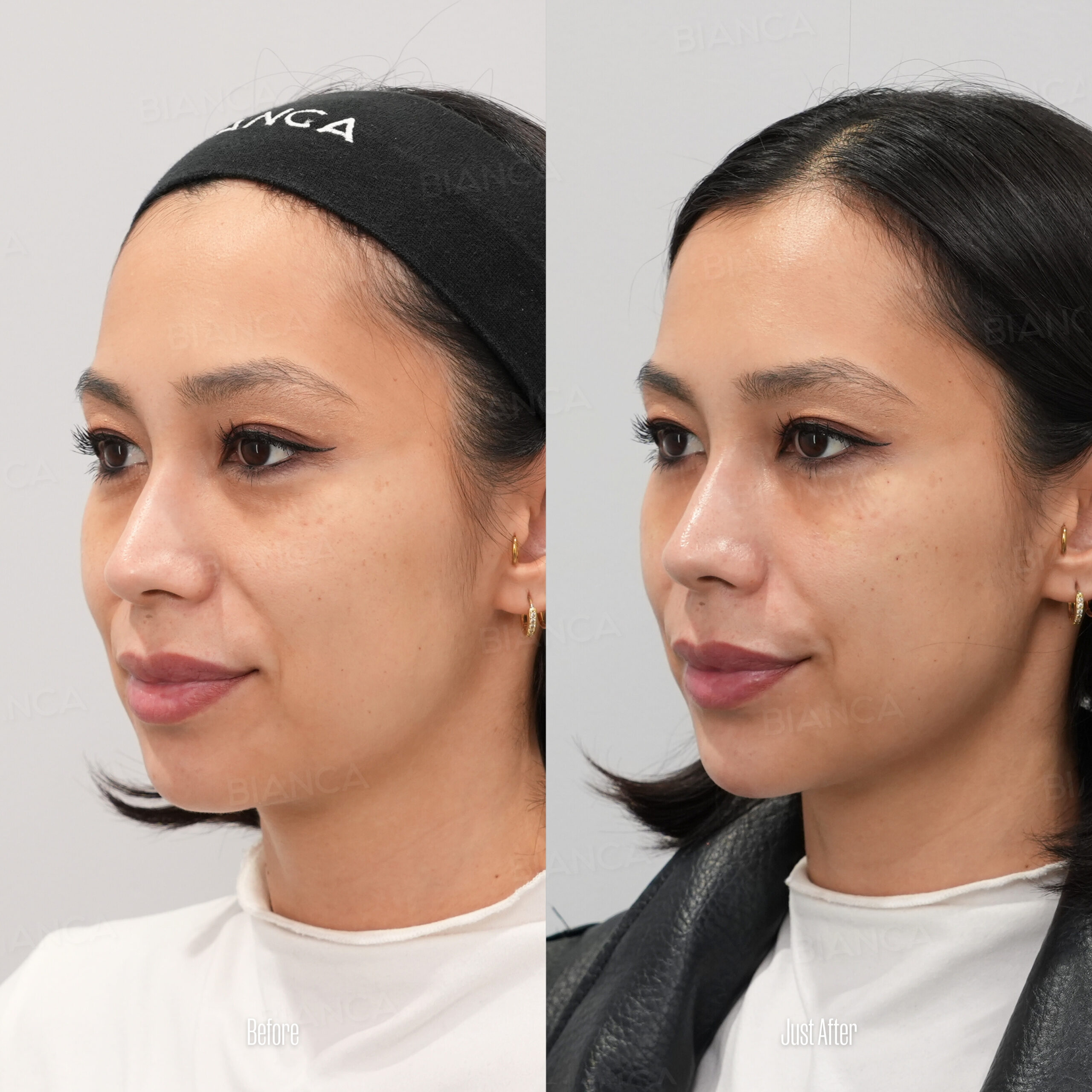 Jawline Filler Treatment: Modern Tokyo Cosmetic Surgery at Its Finest