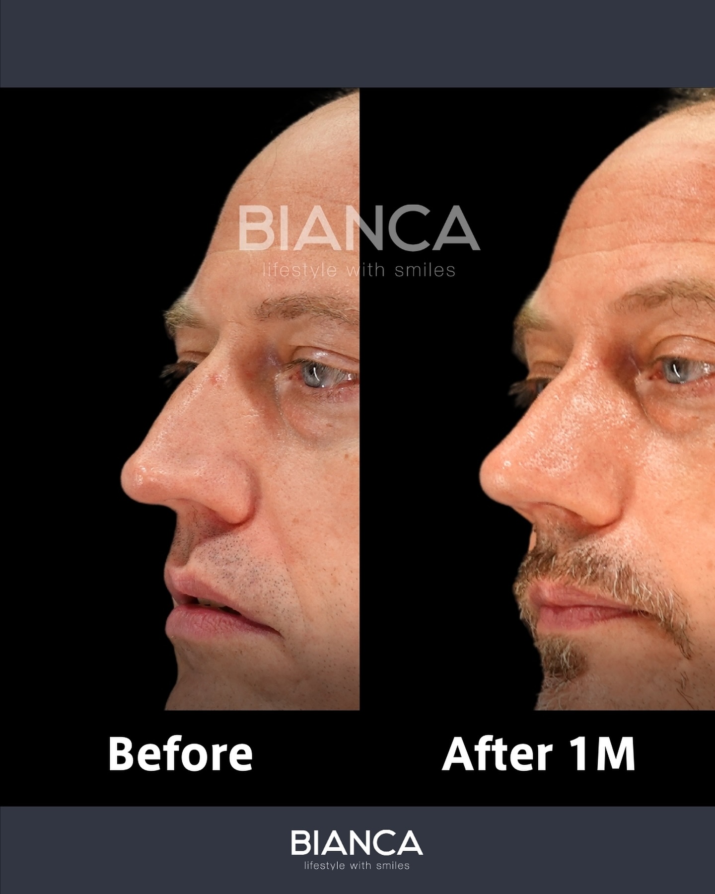 Plastic Surgery in Tokyo | BIANCA CLINIC’s Guide to Safe & Subtle Aesthetics
