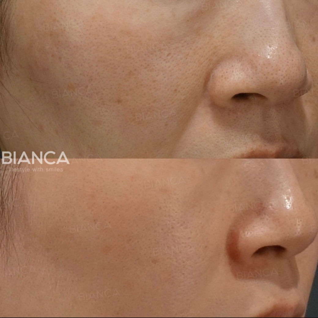 Orange Peel Skin: An Expert Guide to Smoother Texture in Tokyo