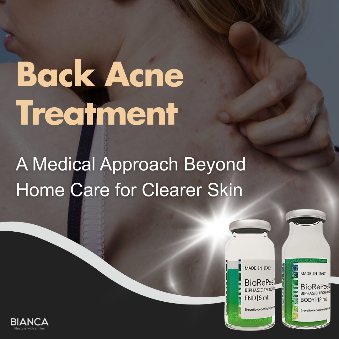 back acne treatment｜Trust BIANCA in Tokyo, Japan for back acne treatment tailored to your skin concerns. back acne treatment BIANCA in Tokyo, Japan