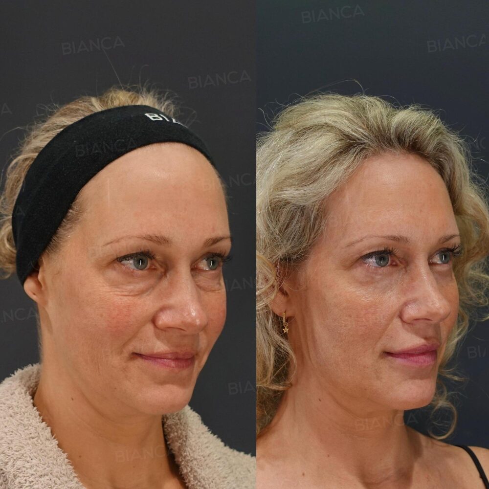 Remove Bags From Eyes: Surgery in Tokyo with Natural-Looking Results