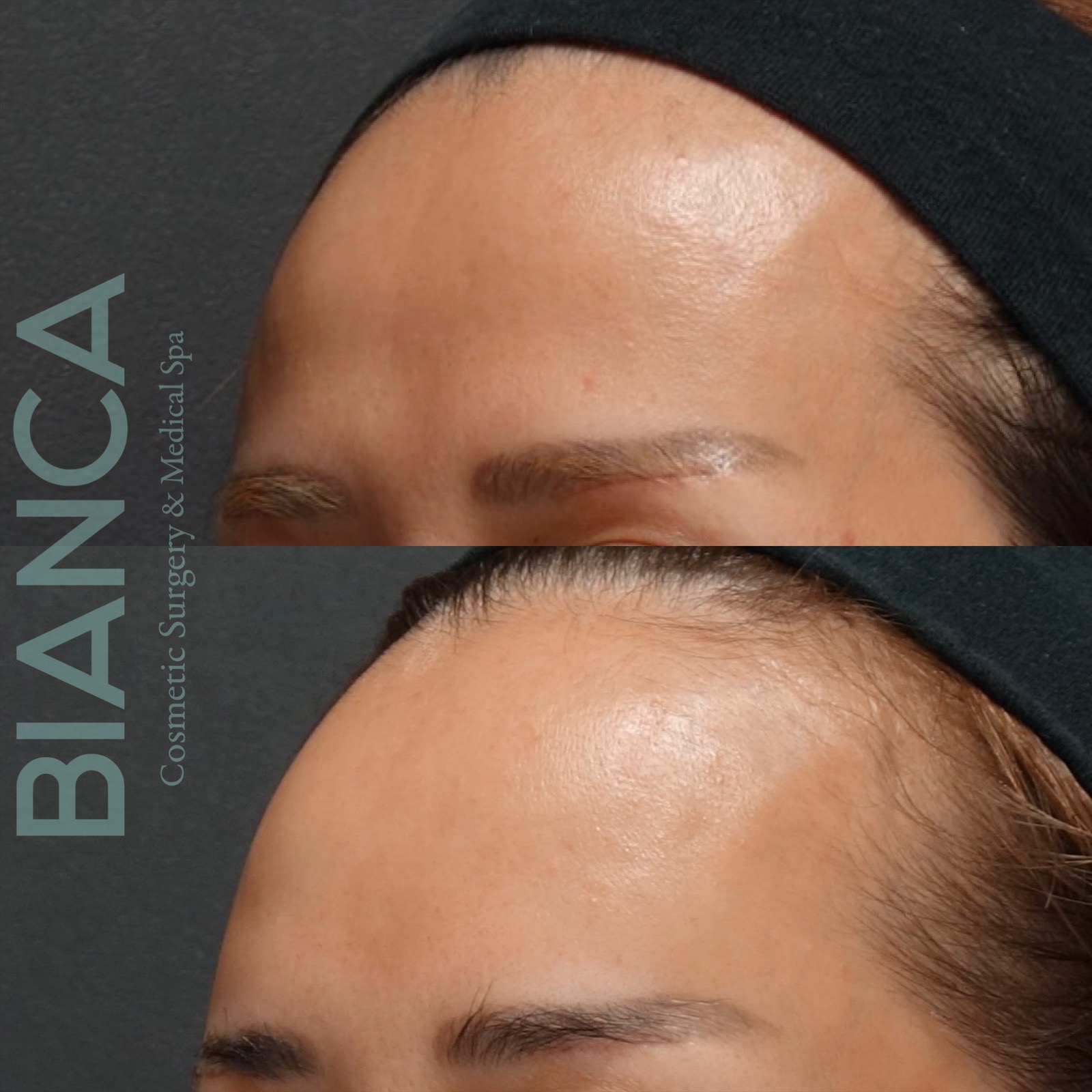 Fillers Voluma: Presenting The Latest Treatments in Aesthetic Surgery