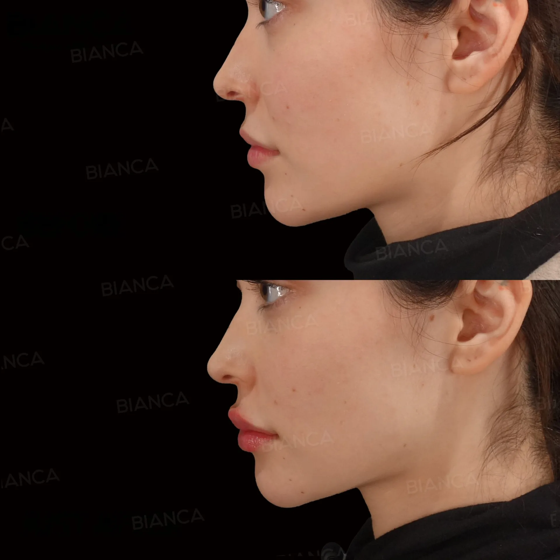Lip Filler Injections Near Me: The Best Kept Cosmetic Surgery Secret in Tokyo