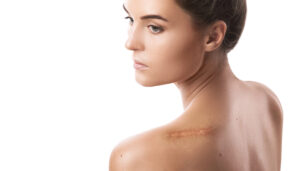 keloid removal｜Trust BIANCA in Tokyo, Japan for keloid