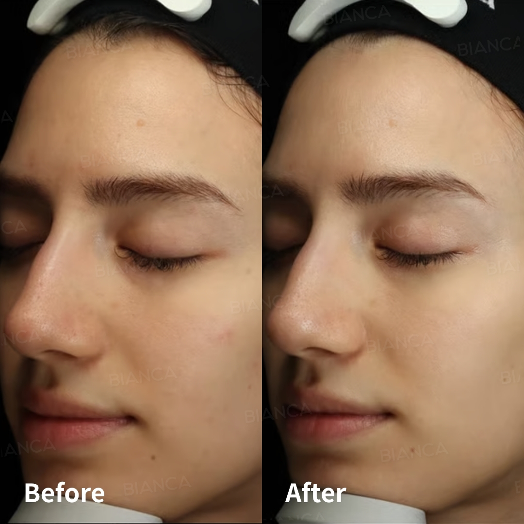 Protected: Hydrafacial® at BIANCA : A Smile as Radiant as Your Skin